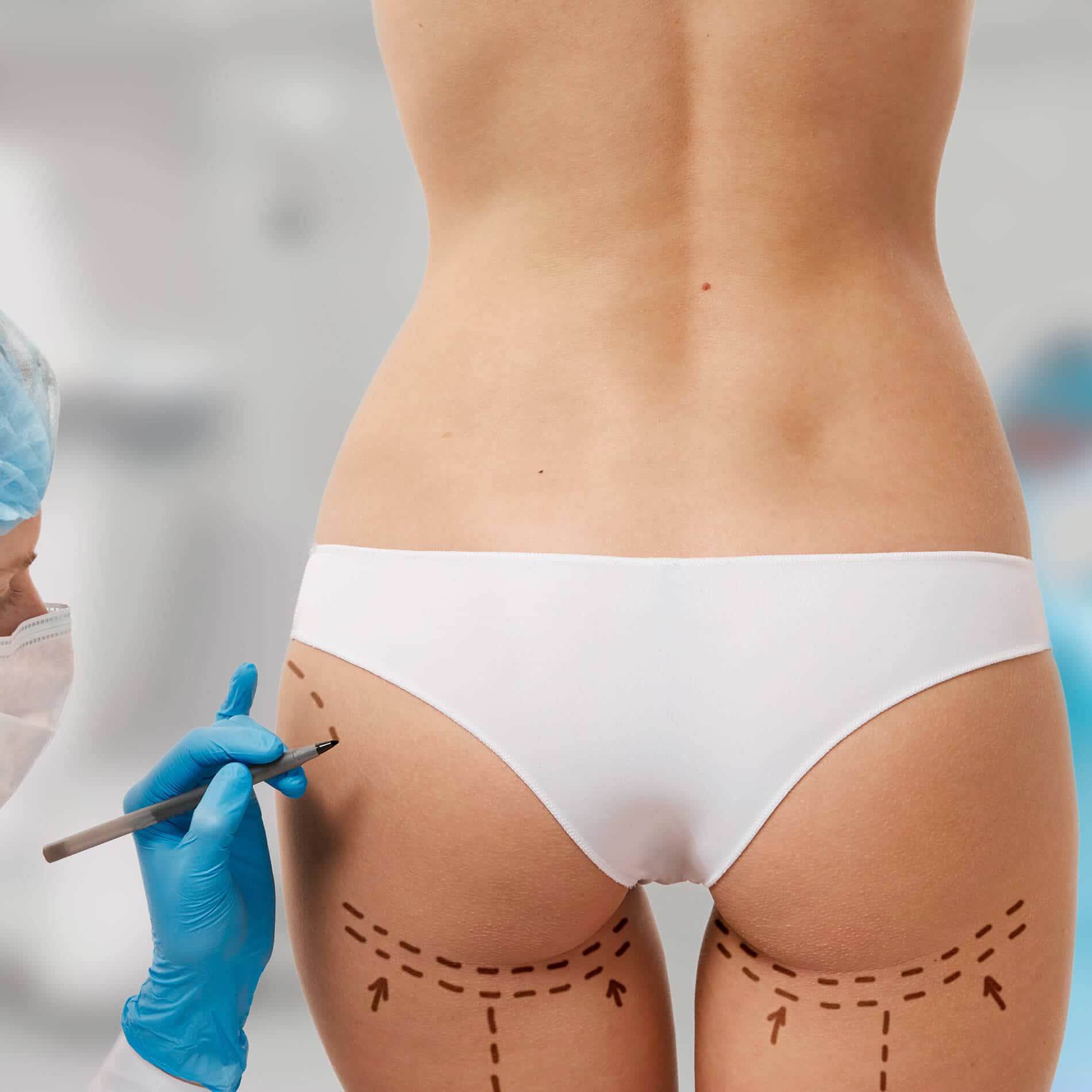 Buttock Implants (3)