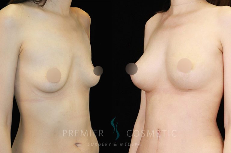 breast fat grafting3