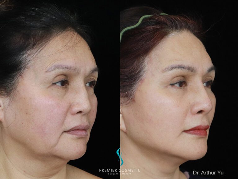 facelift + buccal fat + jawline lipo + lower eyebag + nose injection