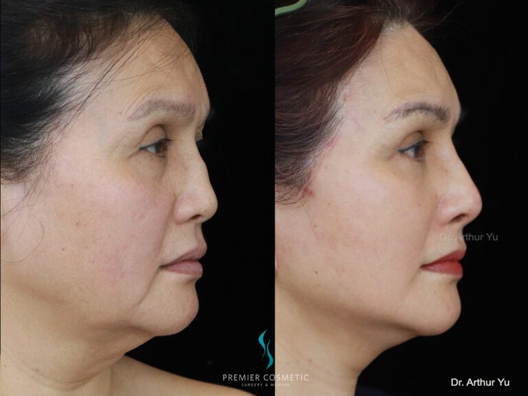 facelift + buccal fat + jawline lipo + lower eyebag + nose injection_90
