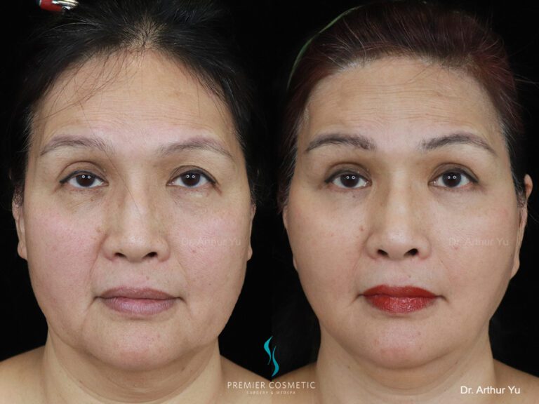 facelift + buccal fat + jawline lipo + lower eyebag + nose injection_front