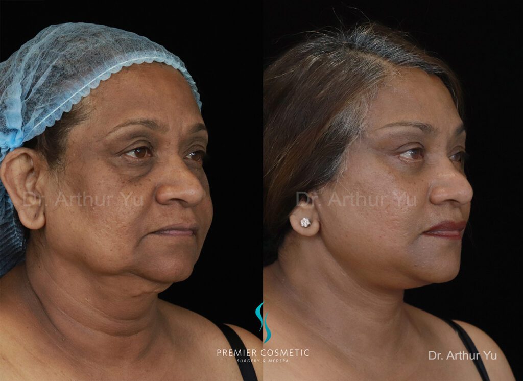 deep facelift neck lift fat grafting buccal fat jawl chin lipo and lower eyelid,45