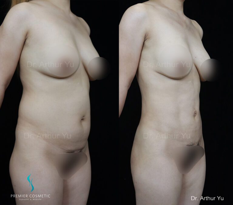 liposuction tummy mid back accessory breast tails and belly button pdo and butt fat grafting-45ins