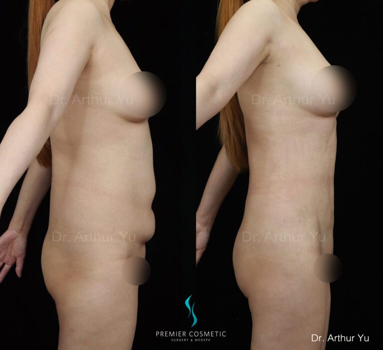 sx 360lipo pdo belly button and breast and butt fta grafting_90ins