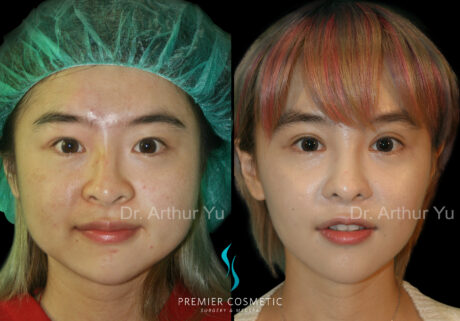 Face Liposuction case #2909