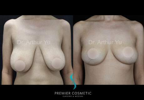 Breast Lift case #2843