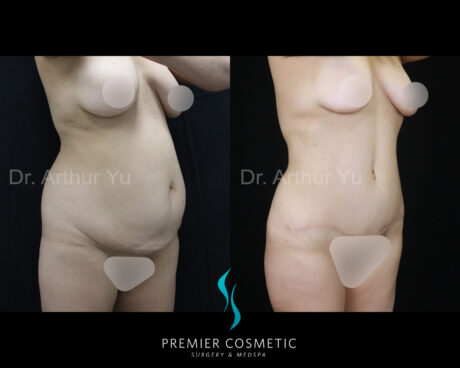 Tummy Tuck case #18209