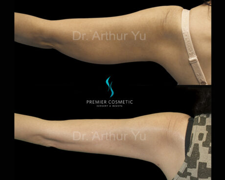 Arm Liposuction case #17435