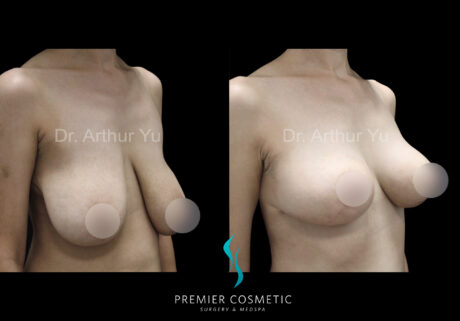 Breast Lift & Breast Reduction case #18253