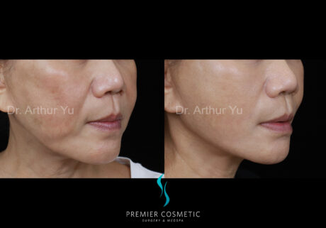 Buccal Fat Removal case #18234