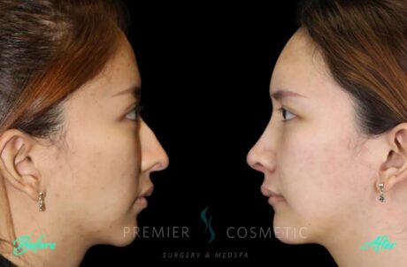 Rhinoplasty case #18222