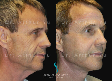 Full Face Fat Grafting case #17531
