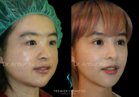 Face Liposuction case #18245