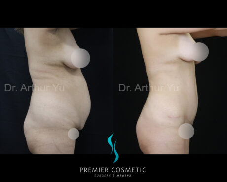 Tummy Tuck case #18208