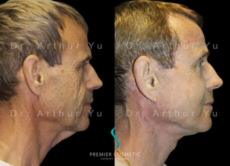 Full Face Fat Grafting case #17532