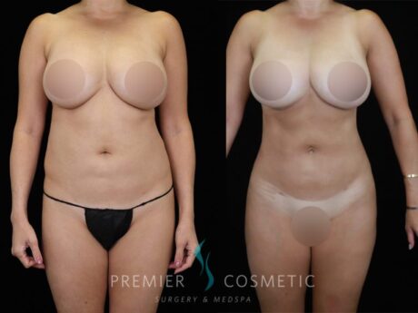 Liposuction case #2140