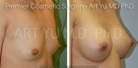 Breast Augmentation With Lift case #1951