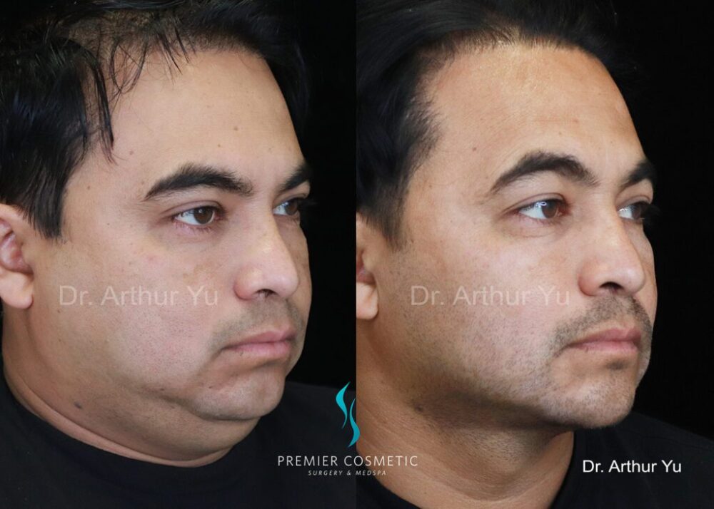Buccal Fat Removal case #1990