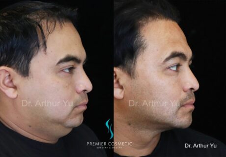 Jowl Fat Removal case #18217