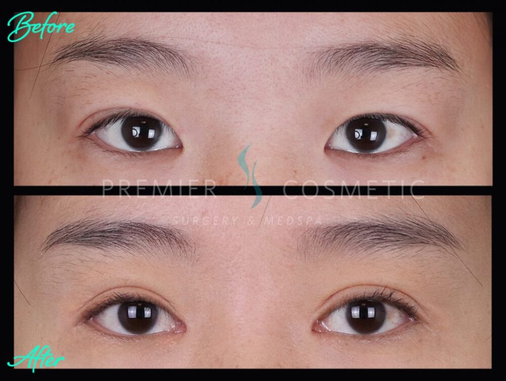 Upper Eyelid Surgery case #2436