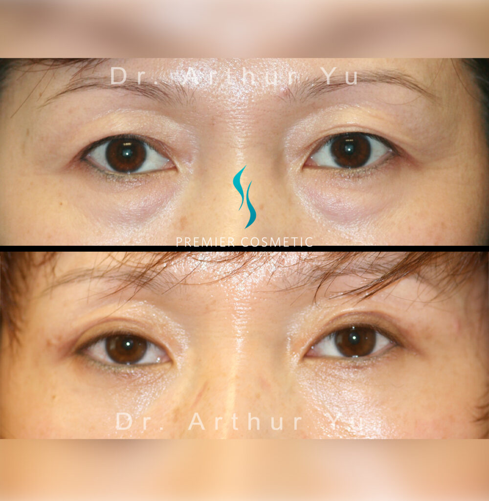 Upper Eyelid Surgery case #3150