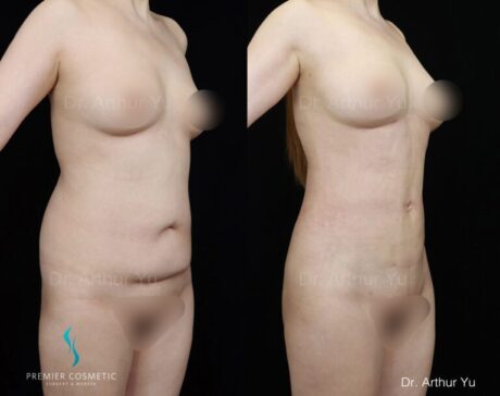 Liposuction case #2168