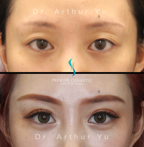 Upper Eyelid Surgery case #3154