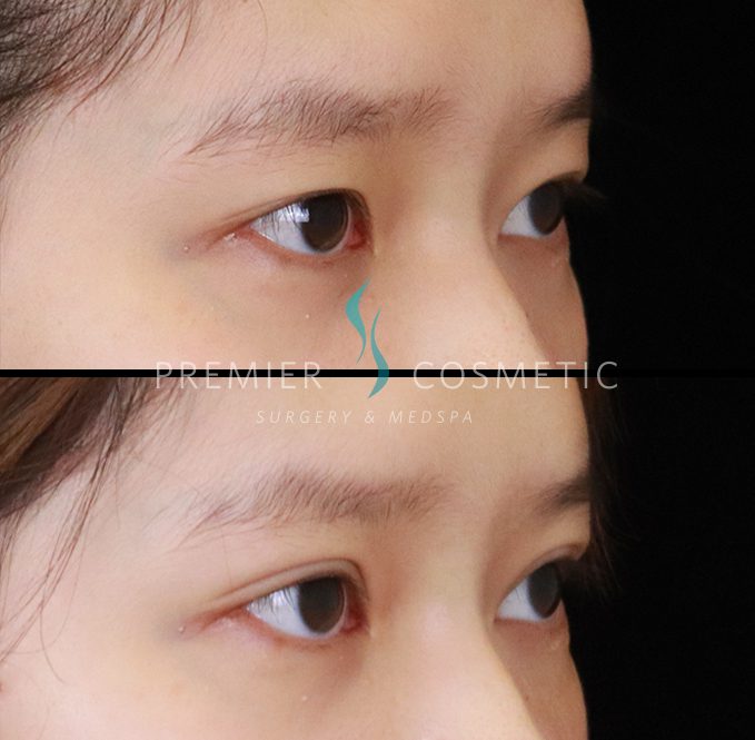 Upper Eyelid Surgery case #2446