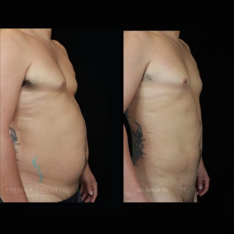 Liposuction case #18198