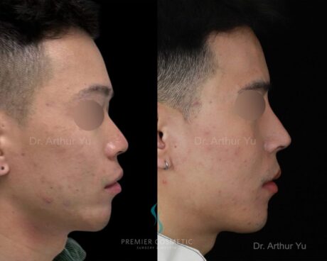 Rhinoplasty case #18219