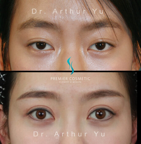 Upper Eyelid Surgery case #3130