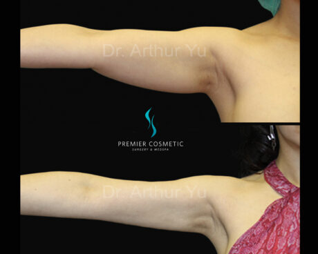 Arm Liposuction case #2810