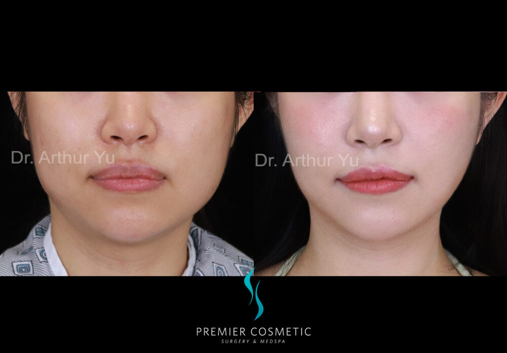 Buccal Fat Removal case #2851