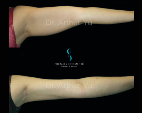 Arm Liposuction case #17434