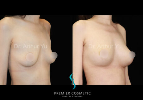 Breast Fat Grafting case #18256