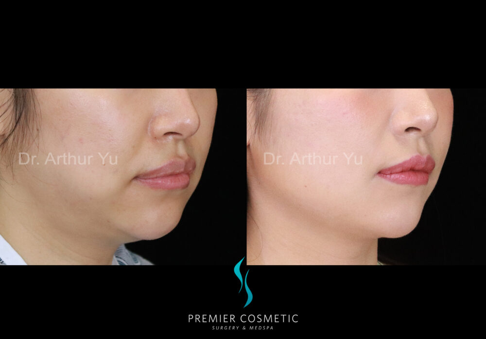 Buccal Fat Removal case #2851