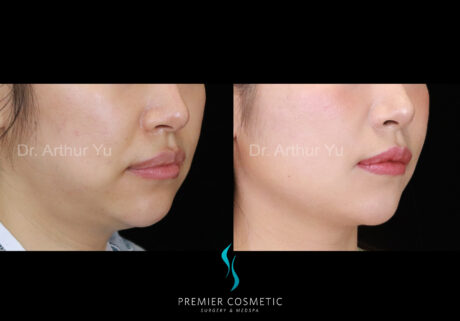 Buccal Fat Removal case #18233