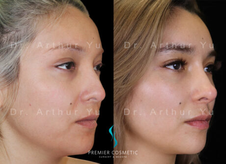 Full Face Fat Grafting case #17530