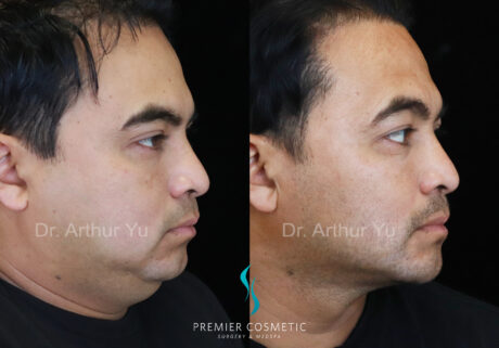 Face Liposuction case #18244