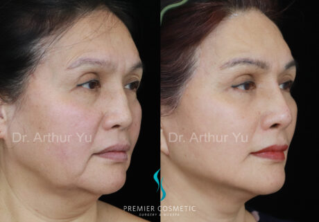 Facelift case #18248