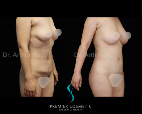 Tummy Tuck case #18207