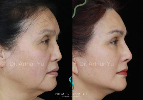Facelift case #18249