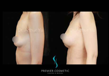 Breast Fat Grafting case #18255