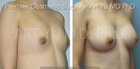 Breast Augmentation With Lift case #1953
