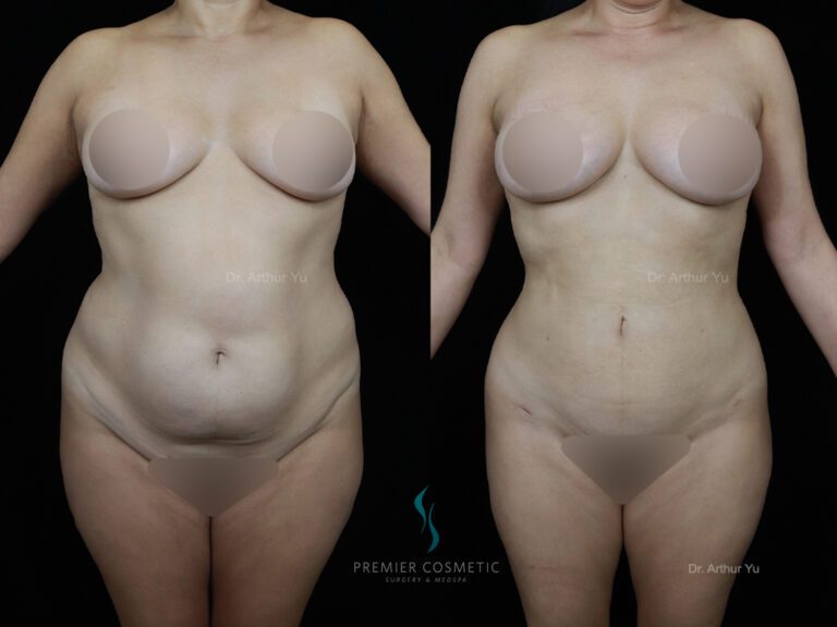 Liposuction case #2142