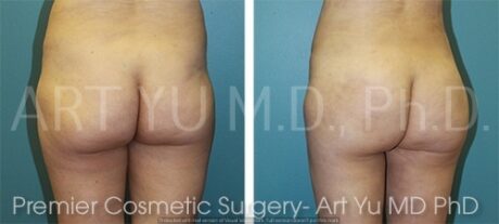 Butt Fat Grafting case #17508