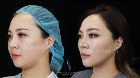 Jowl Fat Removal case #18215