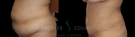 Liposuction case #2188