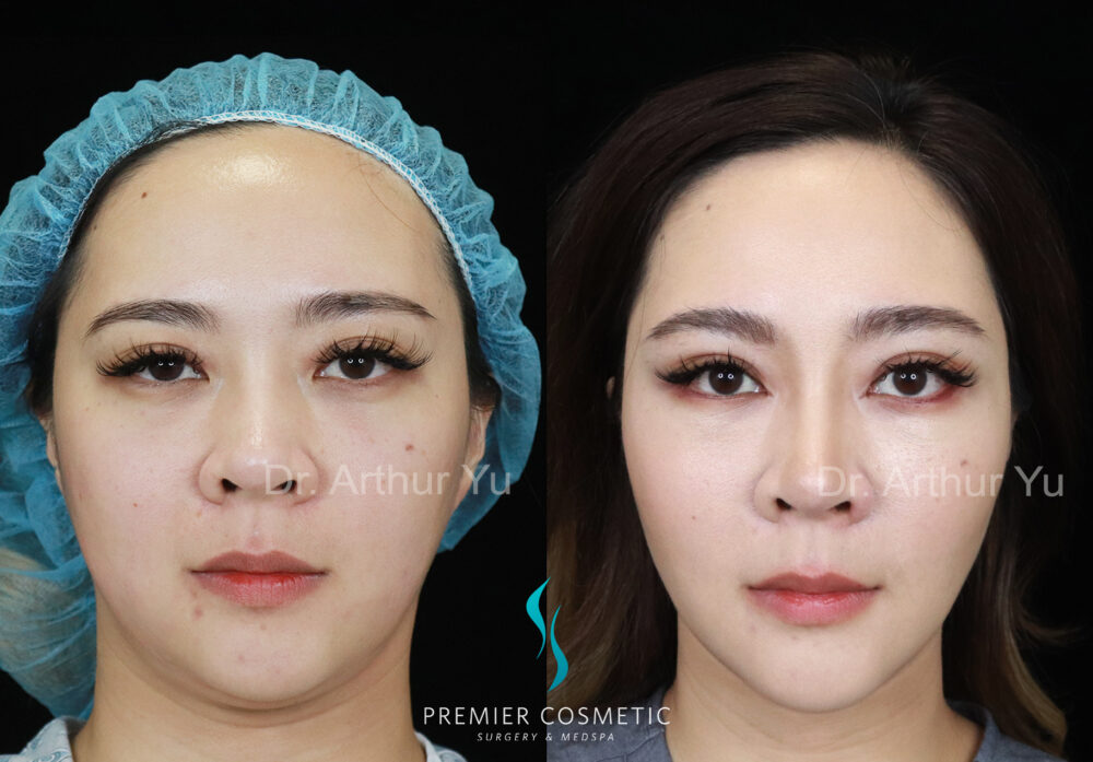 Face Liposuction case #2915