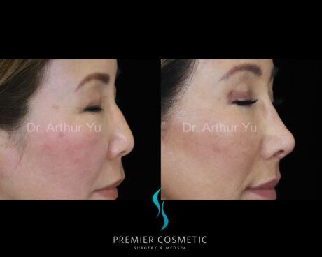 Art TipLyft® case #18266